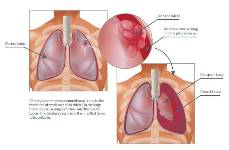 Spontaneous Pneumothorax